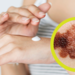 Melanoma: protégete y previene contra rayos solares