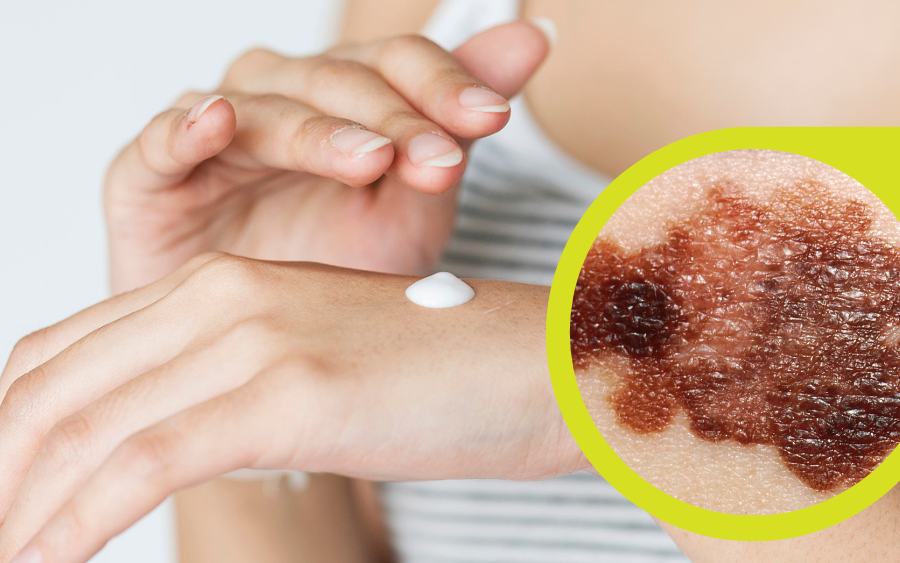 Melanoma: protégete y previene contra rayos solares